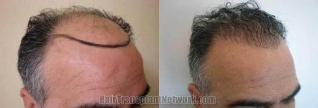 Hair transplantation surgery before and after photos