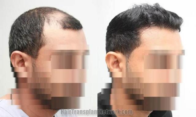 Before and after hair transplantation result photographs