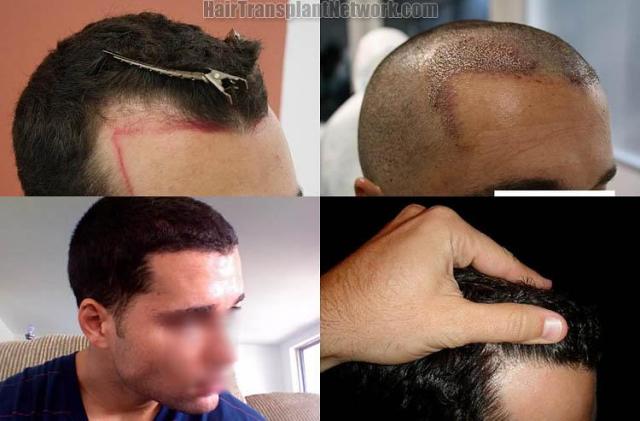 Hair transplantation surgery before and after photos