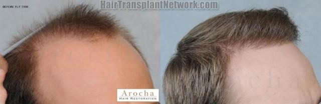 Hair transplantation surgery before and after photos