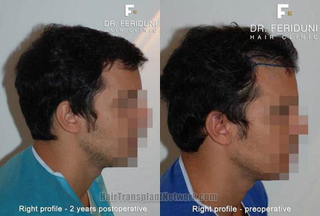 Hair transplantation surgery before and after images