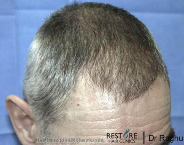 Hair transplantation surgery before and after images