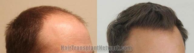 Hair transplantation surgery before and after pictures