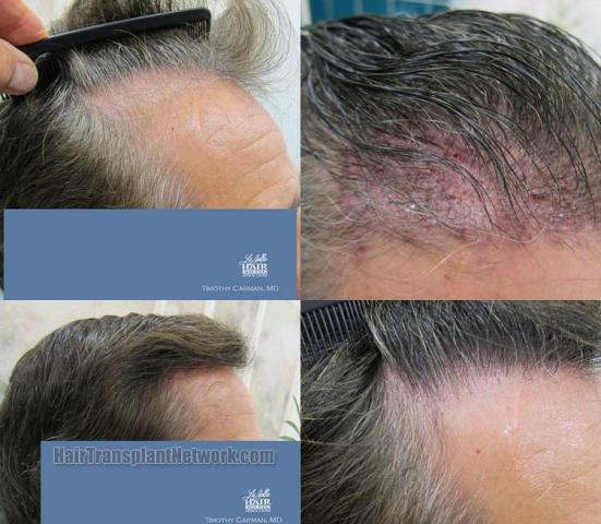 Hair transplantation surgery before and after pictures