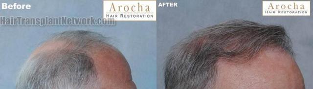 Hair transplantation surgery before and after pictures