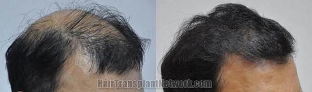 Hair transplantation surgery before and after pictures