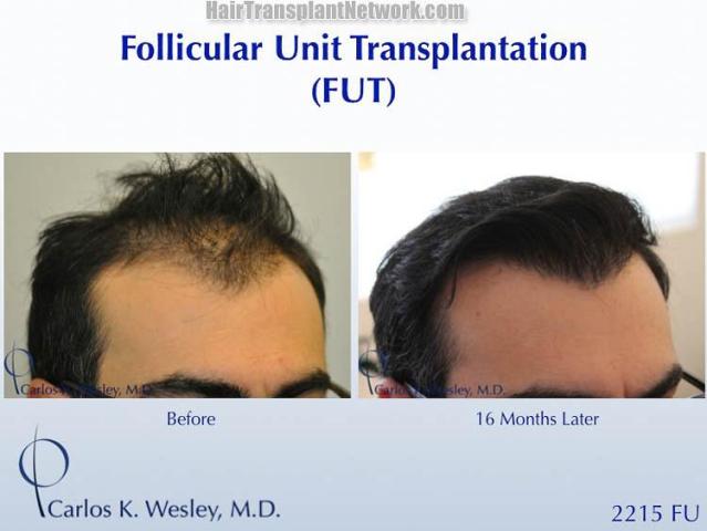 Surgical hair transplantation result photographs