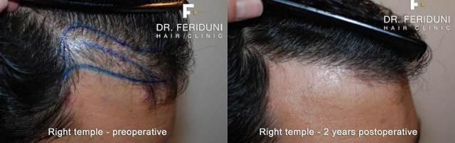 Hair restoration procedure before and after pictures