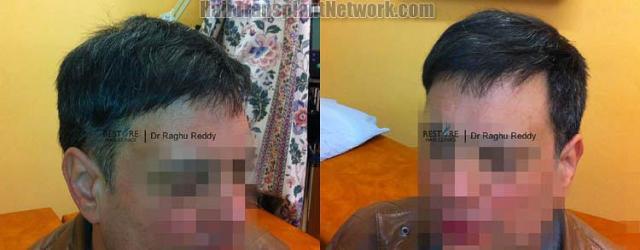 Hair transplantation surgery before and after images