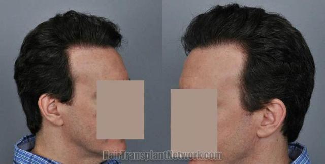 Hair transplantation surgery before and after photos