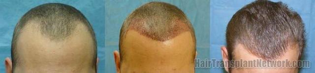 Hair restoration results from 2051 grafts viewed from the top