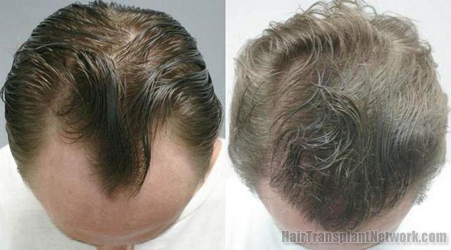 Hair restoration photos - Top view