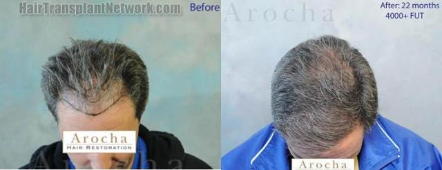 Hair transplantation surgery before and after images