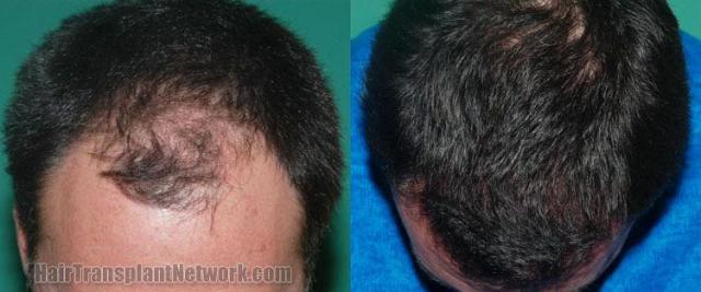 Before and after hair transplant procedure images