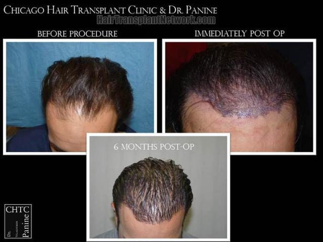 Hair transplantation surgery before and after photos