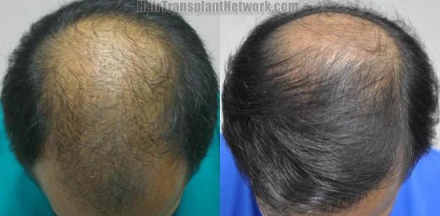 Before and after hair transplant procedure images