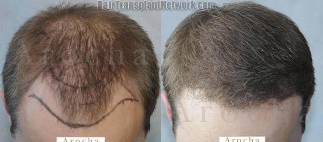 Hair restoration procedure before and after results