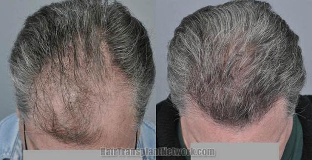 Hair transplantation surgery before and after photos