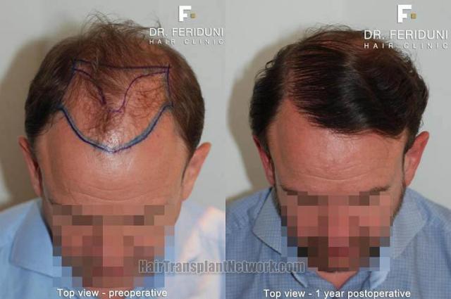 Top view before and after hair restoration results