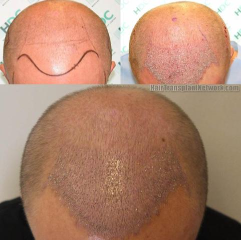 Hair restoration procedure before and after results