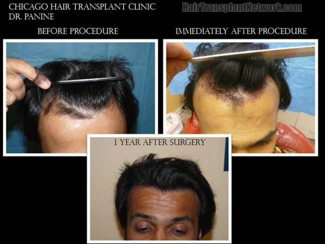 Before and after hair transplant procedure images