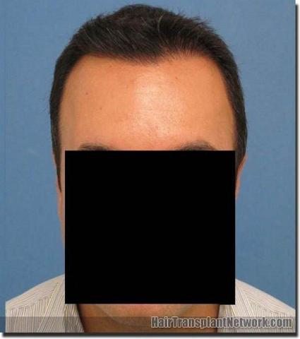 Hair restoration procedure results