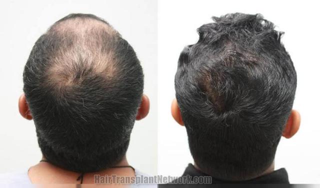 Hair transplantation surgery before and after images