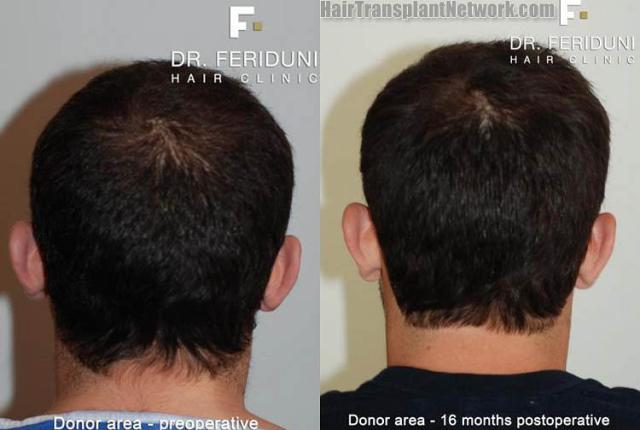 Hair transplantation surgery before and after images