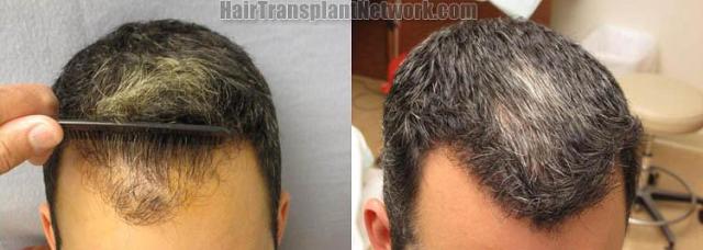 Hair transplantation surgery before and after images