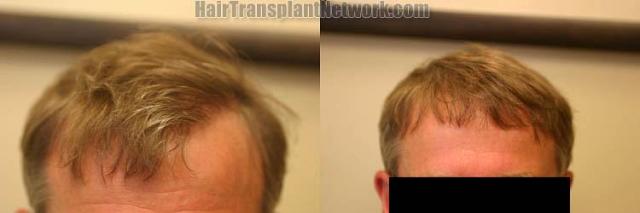 Hair restoration procedure before and after results