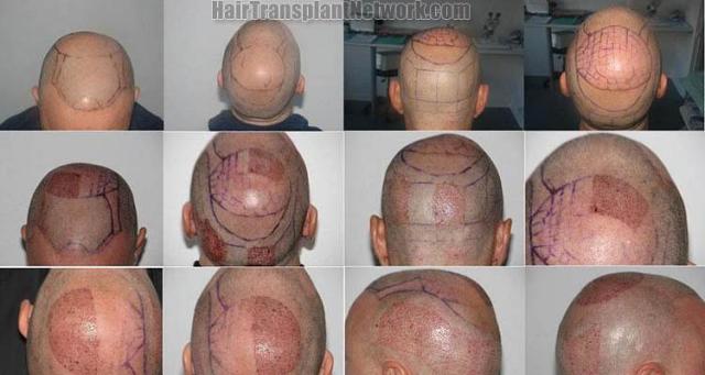 Hair transplantation surgery before and after photos