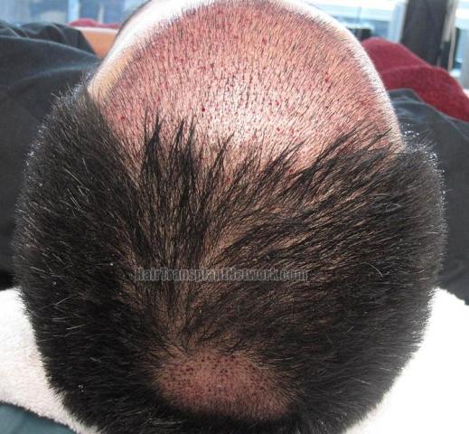 Hair restoration procedure before and after pictures