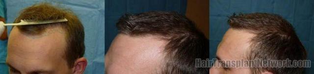 Hair restoration procedure results