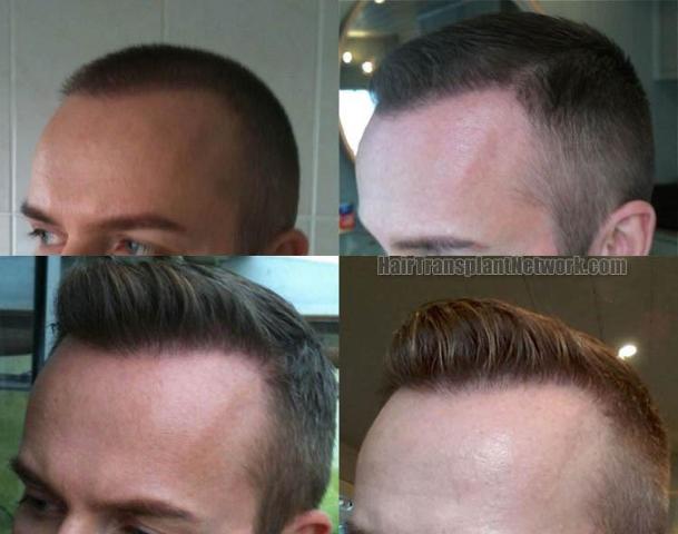 Hair transplantation surgery before and after pictures