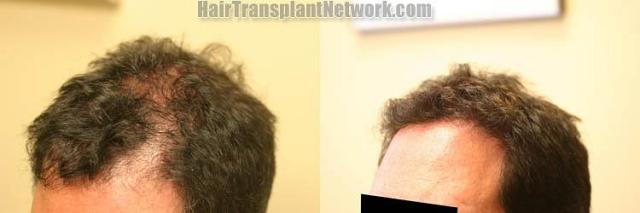 Hair transplantation surgery before and after images