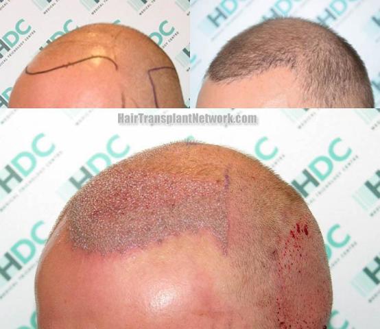 Hair transplantation surgery before and after pictures