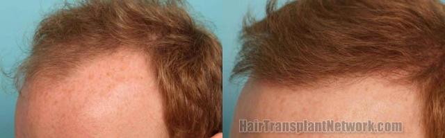 Hair transplantation surgery before and after images