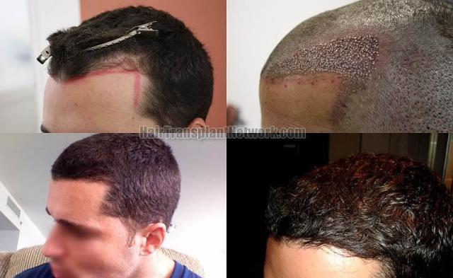 Hair transplantation surgery before and after images