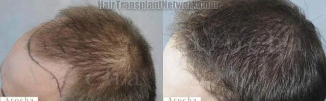 Hair transplantation surgery before and after images