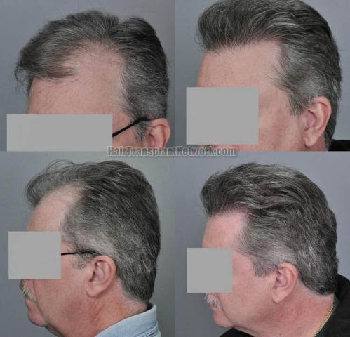 Hair transplantation surgery before and after pictures