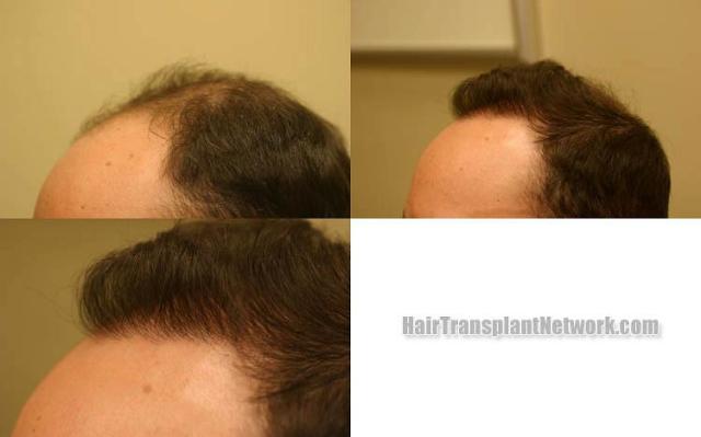 Surgical hair transplantation result photographs