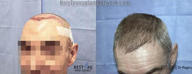 Hair transplantation surgery before and after pictures