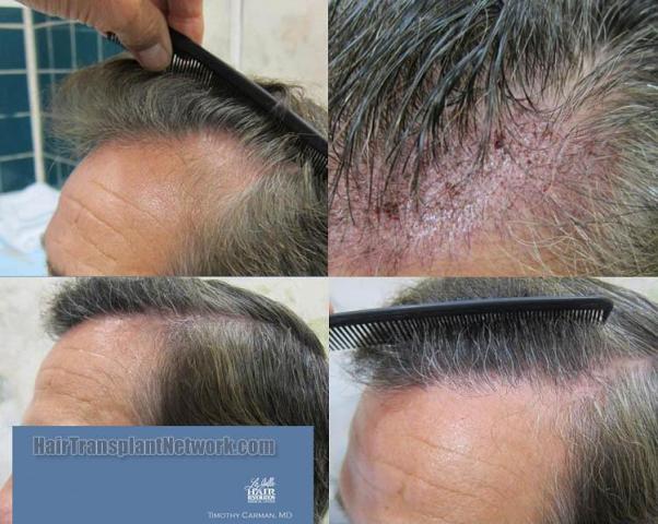 Hair restoration procedure before and after pictures