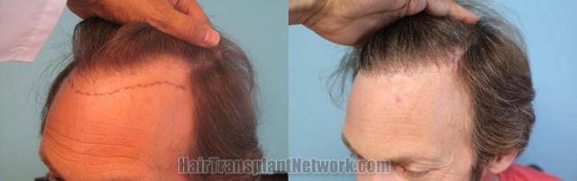 Hair transplantation surgery before and after pictures