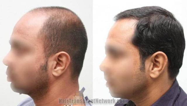 Surgical hair transplantation result photographs