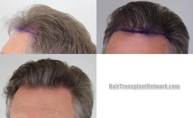 Hair transplantation surgery before and after pictures