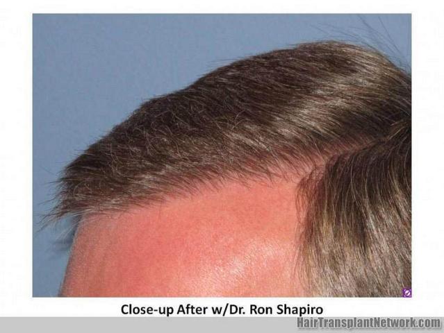 Closeup view of hair restoration results