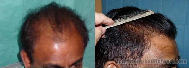 Right side view before and after hair restoration