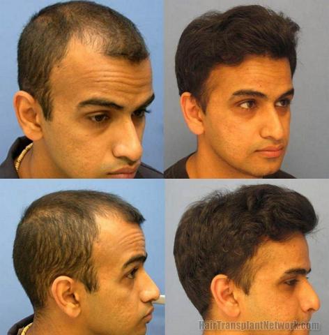 Right  side photos displaying hair transplant results