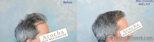 Hair transplantation surgery before and after photos